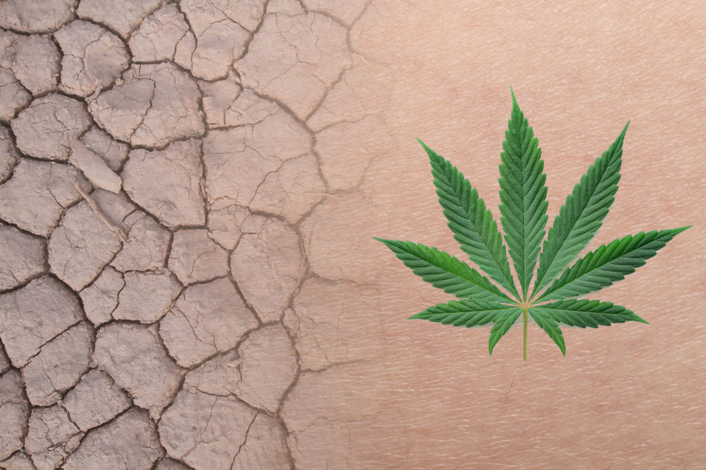 Tratamiento con cannabis para la dermatitis atópica severa